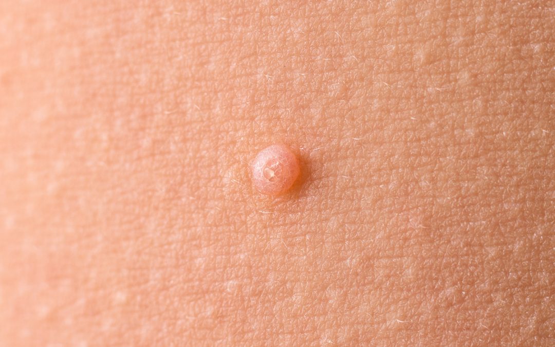 Molluscum in Children, Water Warts, if you believe that your child may have Mollumscum, don’t hesitate to give us a call at The Pediatric Center in Idaho Falls, Idaho. We can help.
