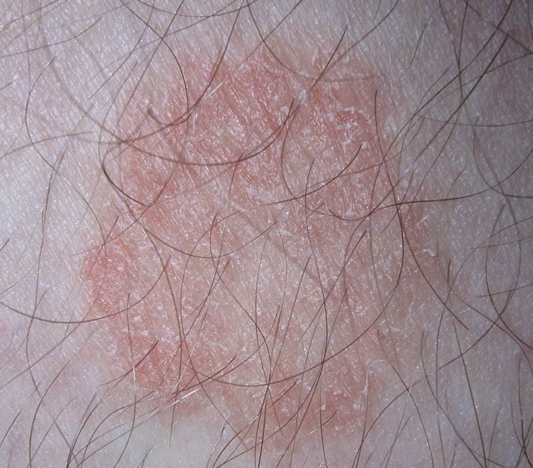 Ringworm in Children, The office visit to diagnose a ringworm infection involves a quick check of the infected areas and is non-invasive. The Pediatric Center in Idaho Falls is a great place to bring your children for a ringworm checkup.